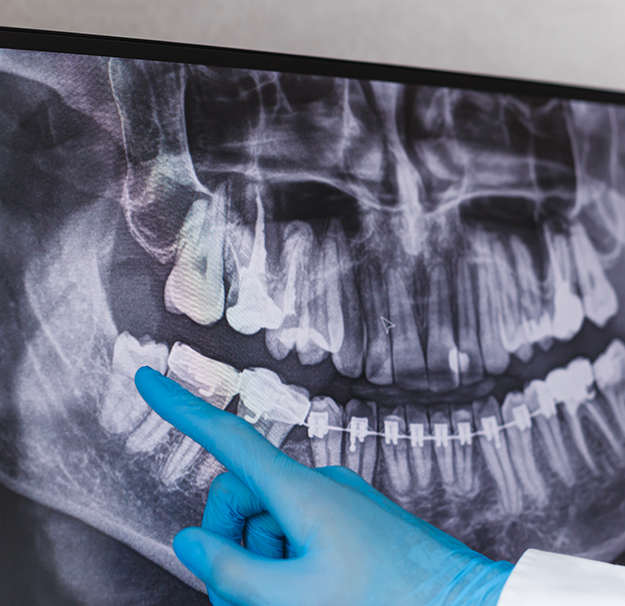 Chirurgie dentaire - Extraction des dents de sagesse - Clinique de santé dentaire Tammy Raymond