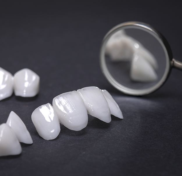 Dentisterie esthétique - Facette et restauration de céramique - Clinique de santé dentaire Tammy Raymond