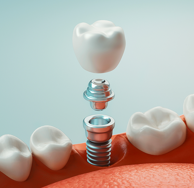 Chirurgie dentaire - Implants dentaires - Clinique de santé dentaire Tammy Raymond