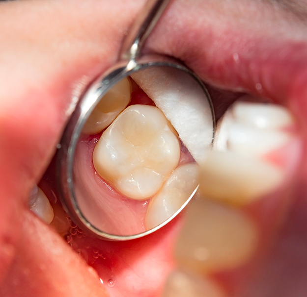 Dentisterie générale - Obturation de dent en composite - Clinique de santé dentaire Tammy Raymond