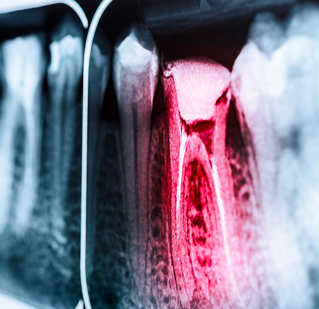 Endodontie - Chirurgies dentaire - Traitement de canal - Clinique de santé dentaire Tammy Raymond